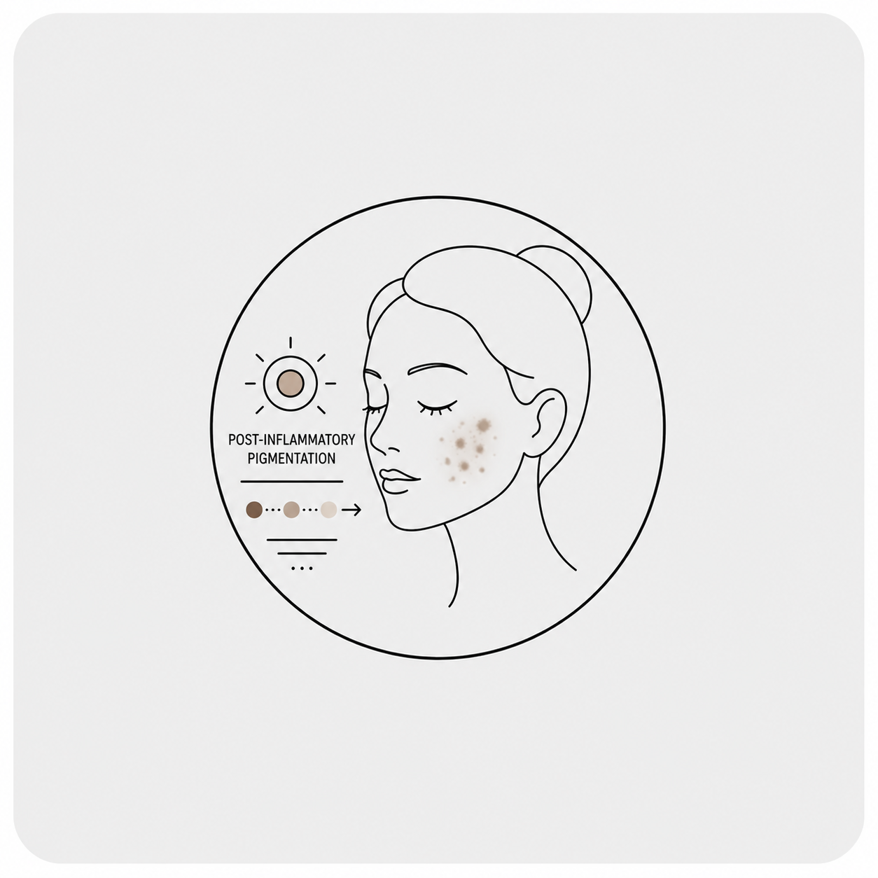 ⁠Post-Inflammatory Pigmentation